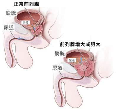 前列腺增生症的早期症状