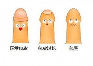 包皮包茎图片
